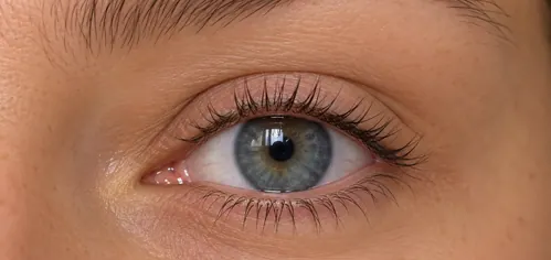 Oog zonder eyeliner, voor de behandeling